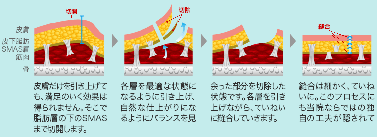 「脂肪・筋肉・皮膚」の3つの層を同時に整え、引っ張る