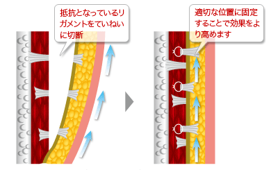 リガメントの処置について