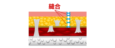 「脂肪・筋肉・皮膚」の3つの層を同時に整え、引っ張る