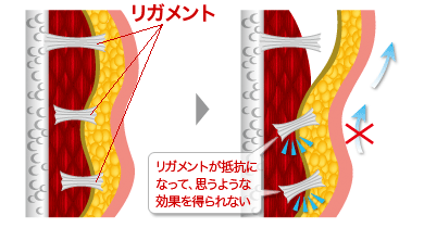 リガメントの処置について