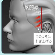 目の縁に沿って点線の部分を切開する。傷跡も残り、腫れも多い。 